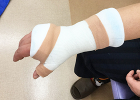 グラスファイバーギプス